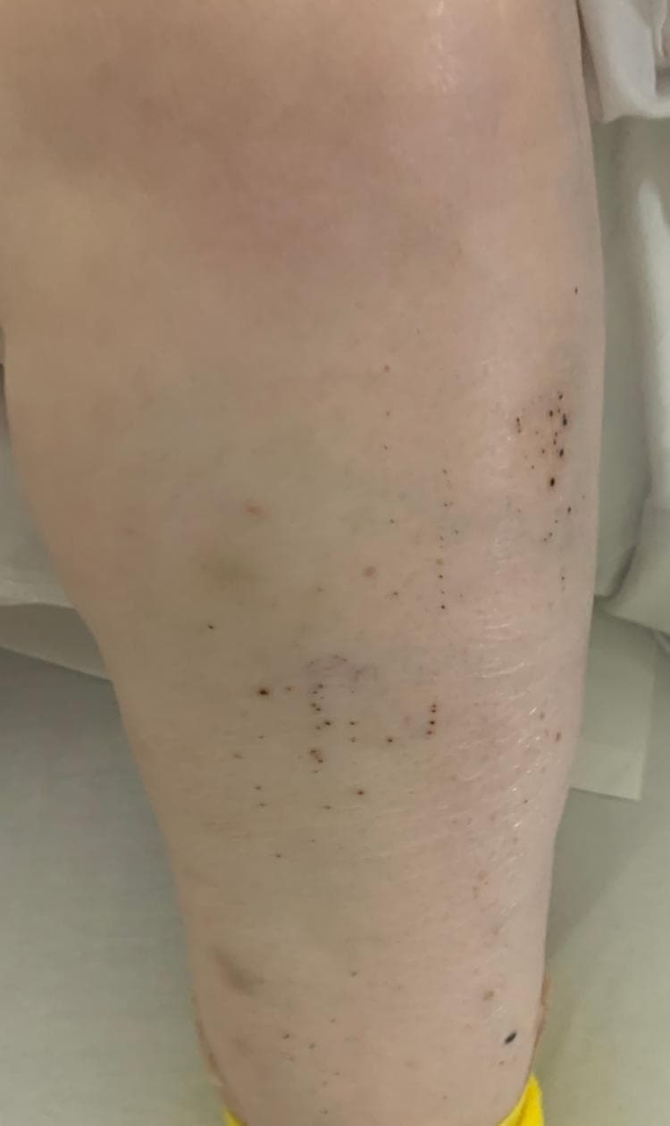Clinical photograph of the left lower extremity demonstrating a localized rash characterized by numerous small, non-blanching, dark red to purplish-black spots consistent with petechiae. The lesions vary from pinpoint size to approximately 2-3 mm in diameter and are distributed in a scattered, patchy pattern across the anterior and lateral leg surface. Centrally, a larger, faint purplish area suggests underlying ecchymosis. The surrounding skin appears otherwise intact without evidence of ulceration or significant scaling. This presentation is highly characteristic of profound thrombocytopenia, such as Immune Thrombocytopenic Purpura (ITP), where low platelet counts lead to spontaneous microvascular hemorrhages within the dermis.