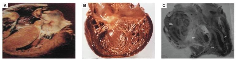 A comparative series of three pathological specimens (gross pathology and diagnostic imaging) illustrating distinct forms of cardiomyopathy. Panel A (Hypertrophic Cardiomyopathy) displays significant concentric hypertrophy of the myocardium, particularly involving the interventricular septum, resulting in a markedly narrowed, slit-like ventricular cavity. Panel B (Dilated Cardiomyopathy) shows a transversely sectioned heart with global ventricular dilation and attenuated, thinned myocardial walls; the trabeculae carneae and papillary muscles are visible within the expanded chambers. Panel C (Endomyocardial Fibrosis) is a radiographic or anatomical section showing structural distortion with characteristic subendocardial thickening and fibrosis. Labeled structures include the right atrium (RA), tricuspid valve (TV), right ventricle (RV), and left ventricle (LV). This panel specifically demonstrates apical obliteration and fibrotic replacement of the endocardium, leading to restrictive physiology. This comparison highlights morphological differences in chamber volume and wall thickness essential for diagnosing heart failure etiologies.