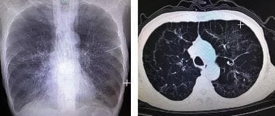 This dual-panel image displays diagnostic thoracic imaging from a patient with Chronic Obstructive Pulmonary Disease (COPD). The left panel is a posterior-anterior (PA) chest X-ray showing classic features of severe emphysema, including hyperinflated lung fields, sparse bronchovascular markings, and a widened chest diameter consistent with a barrel chest deformity. Diaphragmatic flattening and a narrowed mediastinal silhouette are also visible. The right panel is an axial CT scan of the chest (lung window) at the level of the upper lobes, revealing extensive bullous emphysema. Multiple large, thin-walled bullae are visible, particularly in the subpleural regions, along with architectural distortion of the lung parenchyma. These findings demonstrate advanced obstructive lung disease and are clinically significant for explaining symptoms of chronic shortness of breath and impaired gas exchange in elderly patients with a significant smoking history.