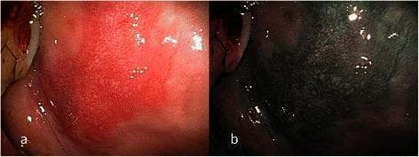 This dual-panel endoscopic image provides a side-by-side comparison of oral erythroplakia on the right buccal mucosa. Image (a) utilizes conventional broadband white light (BWL), revealing a sharply circumscribed, bright red, flat plaque with a velvety texture. Image (b) shows the same lesion under Narrow Band Imaging (NBI), which enhances the visualization of the microvascular architecture. Under NBI, the area exhibits a brownish hue with clearly visible dilated and tortuous intraepithelial papillary capillary loops (IPCL). These vascular changes are classified as IPCL Type II, which are associated with angiogenesis in premalignant lesions. The clinical significance of this finding corresponds to intermediate-grade epithelial dysplasia. The image demonstrates the diagnostic utility of NBI in identifying microvascular morphological patterns—such as vessel winding and crossing—that may be obscured under white light, facilitating the assessment of mucosal lesions in the oral cavity for better triage between benign and dysplastic conditions.