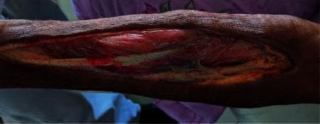 This clinical photograph displays a longitudinal fasciotomy on the left upper limb, performed for the management of compartment syndrome following brachial artery thrombosis. The large, linear surgical incision extends along the forearm, revealing underlying musculoskeletal structures. The exposed muscle tissue appears predominantly viable with a beefy red, striated texture, though some areas exhibit darker, dusky discoloration suggestive of evolving ischemia or injury. Anatomical structures visible within the wound bed include deep fascia, muscular compartments, and white longitudinal structures consistent with tendons or nerve fibers. The surrounding skin is dark and shows a somewhat dry, leathery texture with signs of underlying edema. This image serves as an educational example of emergency surgical decompression used to prevent muscle necrosis and limb loss in the setting of acute vascular compromise and subsequent compartment syndrome.