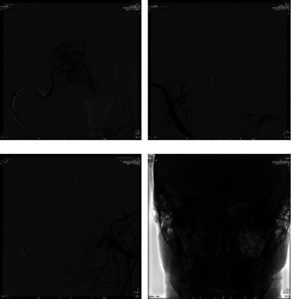 This composite of four images demonstrates the interventional radiology stages of preoperative embolization for a Juvenile Nasopharyngeal Angiofibroma (JNA). Panel (a) is an intraprocedural Digital Subtraction Angiography (DSA) in a posteroanterior (PA) view, showing superselective injection of the distal internal maxillary artery prior to embolization, highlighting the tumor's dense vascular blush. Panels (b) and (c) are post-procedural DSA images in a lateral-lateral (LL) view, illustrating the successful embolization of the lesion's right and left sides, respectively. These views show a near-complete absence of the previously noted vascular blush in the embolized territories. Panel (d) is a post-procedural fluoroscopy frame providing a wide view of the facial skeleton, confirming excellent technical results with the stabilization of the embolic agent (Onyx 18) within the feeder vessels. The primary educational focus is the use of endovascular techniques to achieve devascularization of a hypervascular skull base tumor to minimize intraoperative blood loss during subsequent surgical resection.
