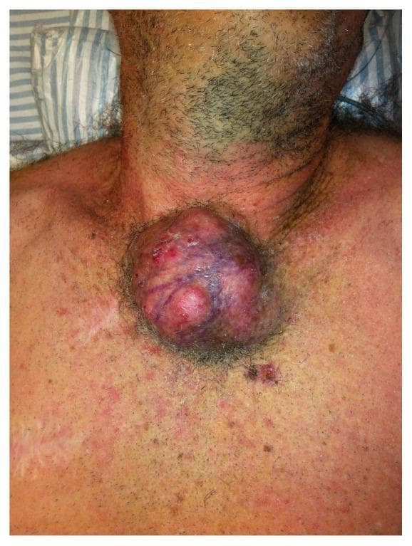 Clinical photograph of a large, exophytic non-melanoma skin cancer (likely basal cell or squamous cell carcinoma) located in the suprasternal and superior sternal region. The lesion presents as a massive, multinodular, and irregularly shaped growth with variegated coloring, including deep red, purple, and violaceous hues suggesting high vascularity or internal hemorrhage. The surface is uneven with visible areas of ulceration, crusting, and focal erosions. Clinically, the mass demonstrates local invasion, potentially involving the manubrium, clavicles, and underlying thoracic structures. The surrounding integument shows significant actinic damage, generalized erythema, and mottled hyperpigmentation. A prominent vertical surgical scar is visible on the left anterior chest wall, suggesting prior intervention. Small satellite lesions and numerous pigmented macules are scattered across the field, indicative of extensive field cancerization in a geriatric patient. This image serves as a clinical example of advanced skin malignancy and the necessity for aggressive surgical resection in cases of deep local invasion.