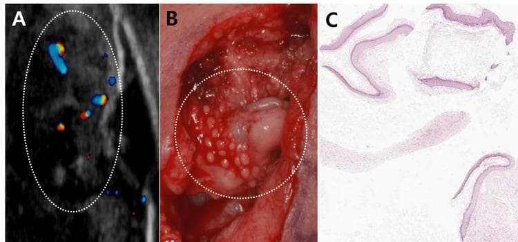 A three-panel figure demonstrating the multimodal diagnostic features of recurrent keloid-associated epidermoid cysts. Panel A shows a color Doppler ultrasonography of the earlobe, revealing multiple hypoechoic, heterogeneous lesions within a dotted oval area, with some internal vascularity signaled by blue and red flow indicators. Panel B is an intraoperative clinical photograph displaying a surgical field with multiple, small, whitish, round cyst-like structures embedded in dense, reddish scar tissue. Panel C presents a histopathological section (H&E stain, 40x magnification) showing multiple cyst walls lined with stratified squamous epithelium and containing lamellated keratin. This composite image illustrates the correlation between preoperative imaging, surgical findings, and definitive pathology for epidermoid cysts arising within keloid tissue, a rare clinical occurrence often triggered by trauma such as ear piercing.