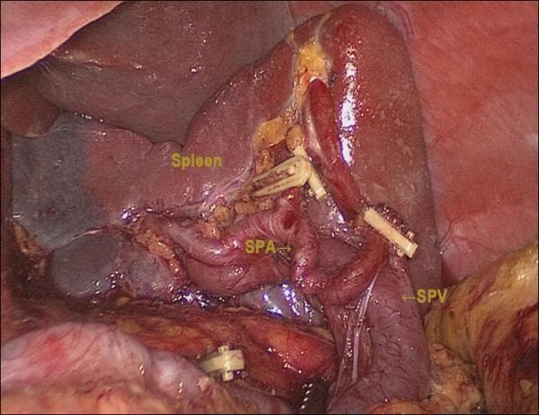This clinical photograph captures a laparoscopic view of the splenic hilum during a surgical dissection, likely a gastrectomy with D2 lymphadenectomy. The primary anatomical structure is the spleen, appearing as a dark red, parenchymal organ. Centrally, the splenic artery (SPA) is identified as a highly tortuous, reddish tubular structure. Inferior and slightly posterior to it is the splenic vein (SPV), which appears wider and more linear. Both vessels have been carefully skeletonized and show the application of surgical hemoclips on distal branches or associated gastric vessels (such as the left gastroepiploic or short gastric arteries), demonstrating vessel ligation and lymph node clearance (Station 10). The surrounding operative field includes fatty connective tissue and reflections of the peritoneum. This image serves as an educational reference for upper gastrointestinal surgeons, illustrating the complex vascular anatomy of the splenic hilum and the precise dissection required for spleen-preserving oncologic surgery.