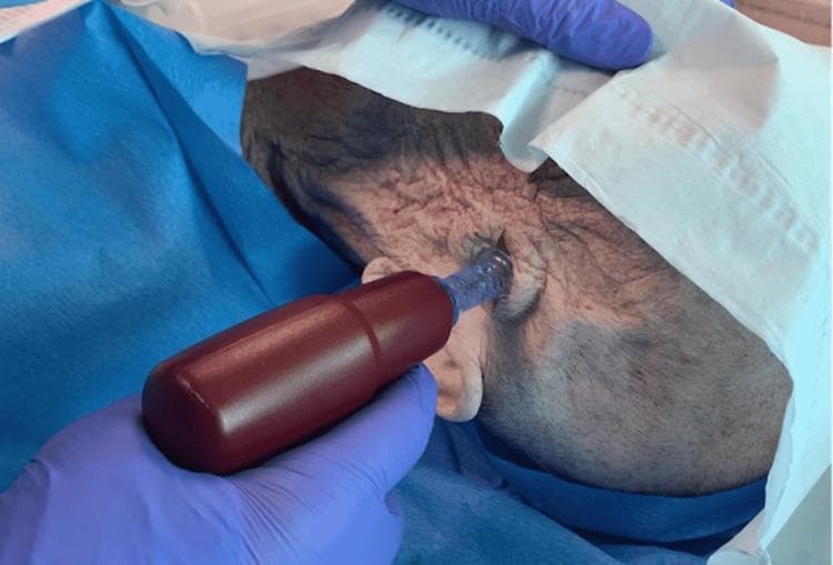 A clinical photograph demonstrating a surgical procedure for an emergency burr hole using an intraosseous (IO) vascular access system on a human scalp. The image shows a gloved hand holding a maroon-handled power driver with an attached clear plastic needle hub. The needle is inserted perpendicularly through a pre-cut cranial-to-caudal incision in the temporal region of the scalp. The patient's scalp is shaved and prepped with a sterile solution, with blue and white surgical drapes defining the sterile field. The needle is positioned to penetrate the skull, intended for the evacuation of an intracranial hemorrhage. This technique illustrates a novel application of IO technology in neurosurgical emergencies to achieve rapid decompression when traditional equipment may be unavailable. The procedure is performed under sterile conditions following identification of anatomical landmarks or CT confirmation.