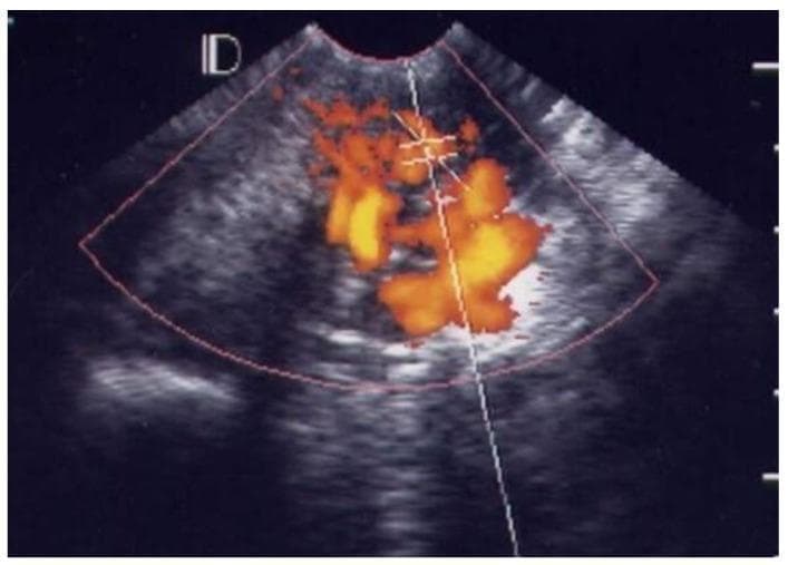 This diagnostic ultrasound image utilizes Color Doppler imaging to visualize the cervix and endocervical canal in a patient diagnosed with Pelvic Inflammatory Disease (PID). The visual demonstrates 'Grade 4' vascularity, which represents the highest clinical category of cervical hypervascularization. The image shows an intense and dense distribution of color Doppler signals (ranging from red to bright yellow) that are spread throughout the entire endocervix and within the endocervical canal. This reticular and confluent pattern of vascular spots signifies severe inflammation and associated angiogenesis within the cervical stroma. Anatomically, the surrounding hypoechoic region represents the cervical tissue, while the central linear echo marks the endocervical canal. This imaging finding is a critical sonographic marker for severe cervicitis, often correlating with decreased Pulsatility Index (PI) and Resistance Index (RI) values during spectral Doppler analysis.