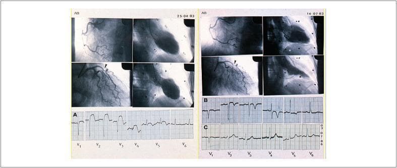 This composite medical image displays a longitudinal clinical case study involving coronary cineangiography, ventriculography, and serial electrocardiograms (ECG). The left panel (dated 25-04-83) depicts acute pathology: the coronary angiogram shows sub-occlusion of the left anterior descending (LAD) artery (arrowhead), and the ventriculogram demonstrates severe systolic dysfunction. Corresponding ECG (A) reveals significant ST-segment elevation in precordial leads V1-V3, consistent with an acute anterior myocardial infarction. The right panel (dated 14-07-83) shows the patient three months later; while the LAD sub-occlusion persists, the ventriculogram shows a notable recovery of left ventricular systolic function. ECG (B) reflects this progression with ST-segment recovery and deep T-wave inversion. A follow-up ECG (C) from 1986 shows a near-normalization of the tracing with the absence of pathological Q waves, suggesting myocardial recovery and a lack of significant residual fibrosis. This image serves as an educational tool for cardiology, illustrating the correlation between angiographic findings, ventricular hemodynamics, and the temporal evolution of ischemic ECG changes.