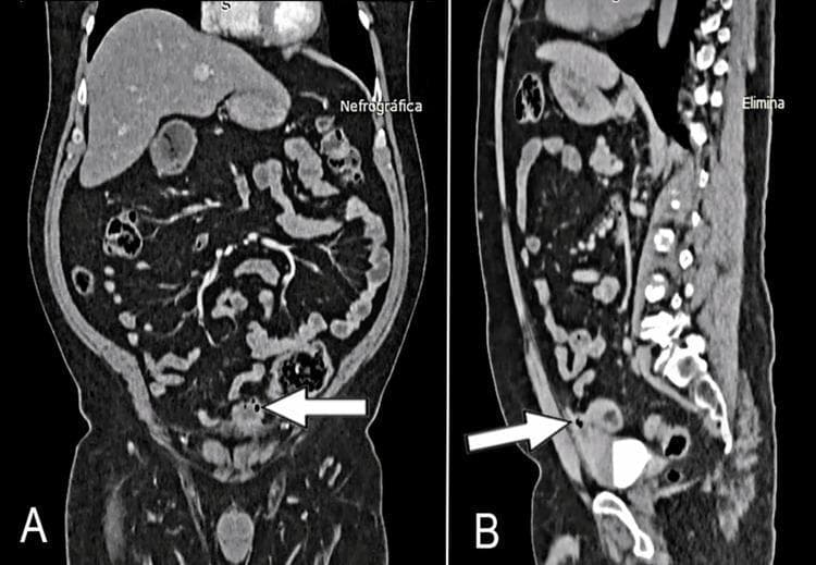 This diagnostic image displays a contrast-enhanced abdominal CT scan in coronal (A) and sagittal (B) views, illustrating a urachal remnant pathology. Image A (coronal) reveals a heterogeneous mass located at the anterosuperior aspect of the bladder dome (indicated by a white arrow). The mass displays irregular morphology and internal foci of gas (hypodense pockets). Image B (sagittal) demonstrates the anatomic continuity of this mass with a patent urachus, appearing as a tubular structure extending superiorly towards the umbilicus within the space of Retzius. Key clinical features include the well-defined margins of the lesion and its relationship with the embryological remnant. These findings are highly characteristic of a urachal cyst or urachal diverticulum, potentially complicated by infection (urachitis) or a urachal neoplasm. The imaging is critical for surgical planning of a partial cystectomy and urachal resection.