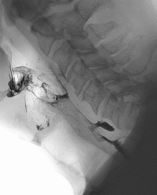 This diagnostic image is a lateral view barium swallow (fluoroscopy/X-ray radiography) of the neck and upper aerodigestive tract. The radiopaque barium contrast medium outlines the pharynx and proximal esophagus. Visible anatomical landmarks include the cervical vertebrae, the mandible, and the soft tissues of the throat. The key pathological finding is a small, posterior outpouching of barium at the level of the pharyngoesophageal junction, specifically at Killian's triangle. This pouch measures approximately 1.1 cm and is characteristic of a Zenker's diverticulum (ZD). The contrast is seen filling the diverticulum as it passes from the hypopharynx into the esophageal lumen. This imaging study illustrates a classic case of a pulsion diverticulum, highlighting its relationship to the posterior pharyngeal wall and its clinical relevance in patients presenting with dysphagia or regurgitation.