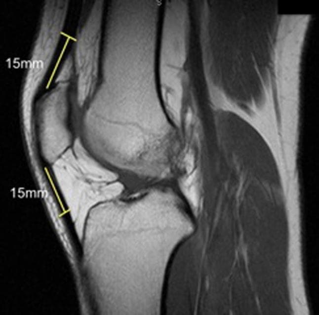 This diagnostic image is a sagittal proton-density magnetic resonance imaging (MRI) scan of the human knee joint, illustrating the anatomy and preoperative measurement protocol for ligament reconstruction. Key visible structures include the distal femur, the patella, the proximal tibia, and the extensor mechanism. The image specifically demonstrates a standardized method for assessing potential donor tissue thickness for autografts, such as Bone-Patellar Tendon-Bone (BPTB) or quadriceps tendon grafts. Two specific measurements are highlighted with yellow lines: a 15 mm segment extending proximally from the superior pole of the patella along the quadriceps tendon, and a 15 mm segment extending distally from the inferior pole of the patella along the patellar tendon. These markers indicate the anatomical locations where tendon thickness should be measured to evaluate graft suitability. The clinical focus of the image is orthopedic preoperative planning for Anterior Cruciate Ligament (ACL) reconstruction, providing a quantitative approach to individualizing surgical graft selection based on the patient's native anatomy.