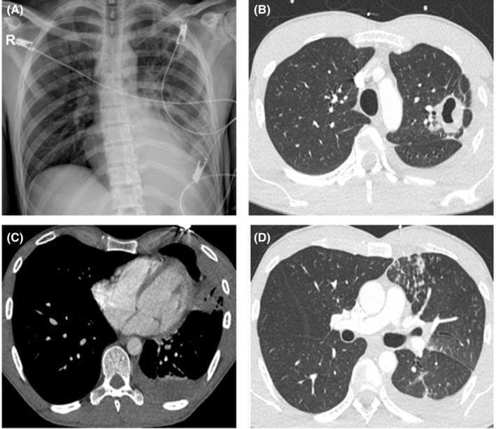This composite figure displays diagnostic imaging of the chest from a patient with pulmonary tuberculosis. Panel A is a posterior-anterior chest X-ray revealing a prominent, thick-walled cavitating lesion in the left pulmonary apex, accompanied by patchy alveolar infiltrates in the left lower lobe and blunting of the left costophrenic angle suggestive of pleural effusion. Panels B, C, and D provide axial thoracic CT scans in lung and soft tissue windows. These images demonstrate a large, irregular left apical cavity containing a hydro-aerial (air-fluid) level. Additional findings include multiple inflammatory nodules, evidence of ipsilateral endobronchial dissemination (tree-in-bud appearance), and a localized left-sided pleural effusion. The imaging collectively illustrates classic radiographic features of secondary (reactivation) tuberculosis, emphasizing cavitary destruction and bronchogenic spread within the respiratory system.