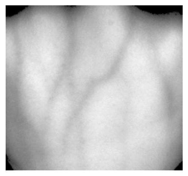 This clinical diagnostic image shows a gray-normalized region of interest (ROI) of a human dorsal hand vein network, captured using infrared (IR) light source imaging. The visual demonstrates the subcutaneous venous pattern, where veins appear as dark, branching longitudinal structures against a lighter, normalized background representing skin and subcutaneous tissue. The image highlights the superficial venous anatomy of the dorsum of the hand, specifically illustrating the interconnectivity and morphology of the veins. The texture is characterized by a soft, blurred appearance typical of near-infrared transillumination or reflectance imaging, which utilizes the light-absorption properties of deoxygenated hemoglobin to map vascular structures through the skin. This type of imaging is medically significant for vascular access, biometrics, and the study of peripheral venous distribution and variations.