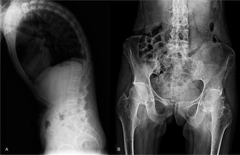 This composite diagnostic image consists of two X-ray radiographs illustrating radiographic manifestations of Ankylosing Spondylitis (AS). Panel A is a lateral view of the spine showing a significant thoracic kyphosis. Key findings include 'squaring' of the vertebral bodies, sclerosis along the vertebral margins, and calcification of the anterior longitudinal ligament (syndesmophytes). The facet joints appear blurred with narrowing or disappearance of the joint spaces. Panel B is an anteroposterior (AP) pelvis radiograph showing bilateral sacroiliitis, characterized by blurred articular surfaces of the sacroiliac joints. The image demonstrates the skeletal progression of a spondyloarthropathy, emphasizing the structural changes in the axial skeleton and pelvic girdle including vertebral fusion and joint erosion. These features are clinically significant for diagnosing advanced autoimmune inflammatory arthritis in the rheumatology domain.