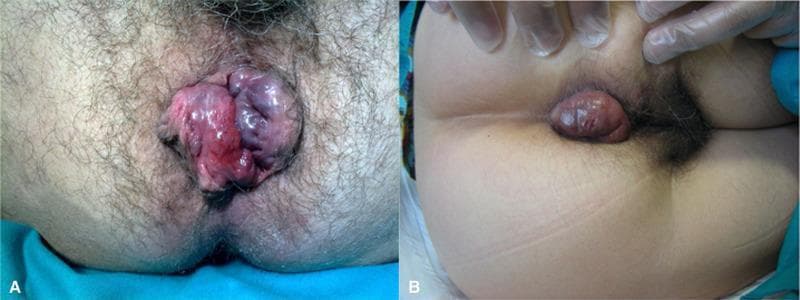 Two clinical photographs (A and B) depicting external anal masses consistent with thrombosed hemorrhoids and perianal lesions. Image A shows a large, multi-lobulated, and irregular mass protruding from the anal verge. The lesion exhibits significant color variation, including areas of deep purple, cyanotic hues, and bright erythema, with a glistening, moist surface texture suggestive of edema or incarceration. The mass largely obscures the anal opening. Image B demonstrates a more localized, ovoid perianal lump. It is characterized by a reddish-brown color that contrasts with the surrounding pale skin. The surface appears tense and smooth but with focal areas of ecchymosis and minor skin abrasions. These images serve as educational examples for differentiating the morphological presentations of acute perianal vascular conditions and external hemorrhoidal disease in a colorectal or primary care clinical context.
