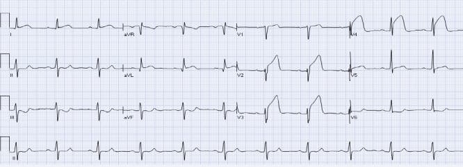 This diagnostic image is a 12-lead electrocardiogram (ECG) demonstrating an acute anterior ST-elevation myocardial infarction (STEMI). The tracing reveals significant concave ST-segment elevation in the high lateral lead aVL and the anterior precordial leads V2, V3, and V4. These findings are highly suggestive of a proximal occlusion of the left anterior descending (LAD) coronary artery. Accompanying these changes is evident reciprocal ST-segment depression in the inferior leads III and aVF, which confirms the acute nature of the ischemic event. The ECG also shows hyperacute T waves in the affected precordial leads and preserved R-wave progression in the early stages of this infarction. This visual material is a primary educational resource for cardiology and emergency medicine, teaching the identification of ST-segment changes and the concept of reciprocal leads in localizing myocardial ischemia.