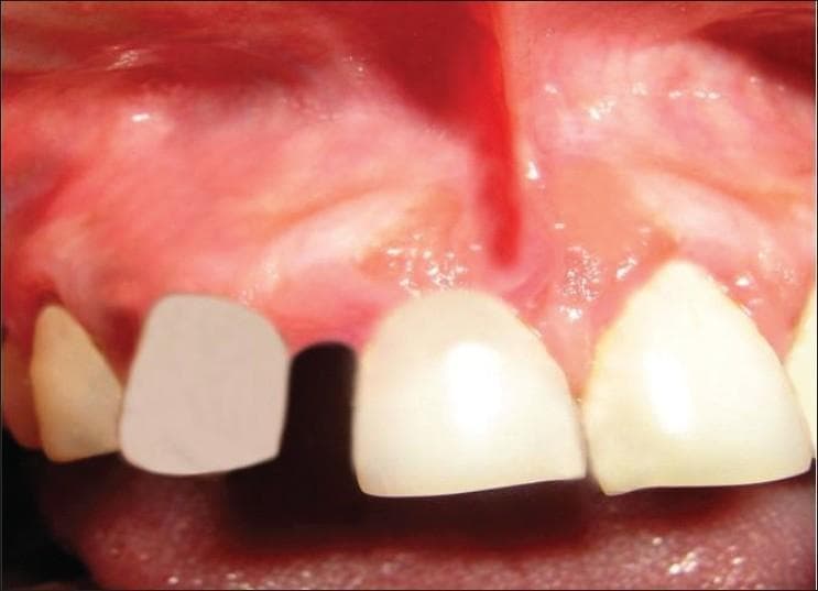 This intraoral clinical photograph provides a postoperative view of the maxillary anterior gingiva and teeth three months following the excision of a peripheral cemento-ossifying fibroma. The image focuses on the right maxillary quadrant, showing the labial gingiva, alveolar mucosa, and the labial frenum. The gingiva appears generally healthy and coral pink, though localized areas of mild erythema and slight edema are visible, particularly at the interdental papilla and the surgical site margins. The site of previous pathology shows successful tissue healing with no evidence of immediate recurrence. There is a notable edentulous space (diastema) between the existing anterior teeth, consistent with previous pathological migration or tooth loss. The visible teeth show varying shades, with one tooth presenting a flatter, opaque appearance suggestive of a provisional restoration or prosthetic. The surrounding alveolar mucosa shows normal vascularity. This image is used to demonstrate long-term follow-up and clinical healing after the surgical management of reactive gingival lesions.