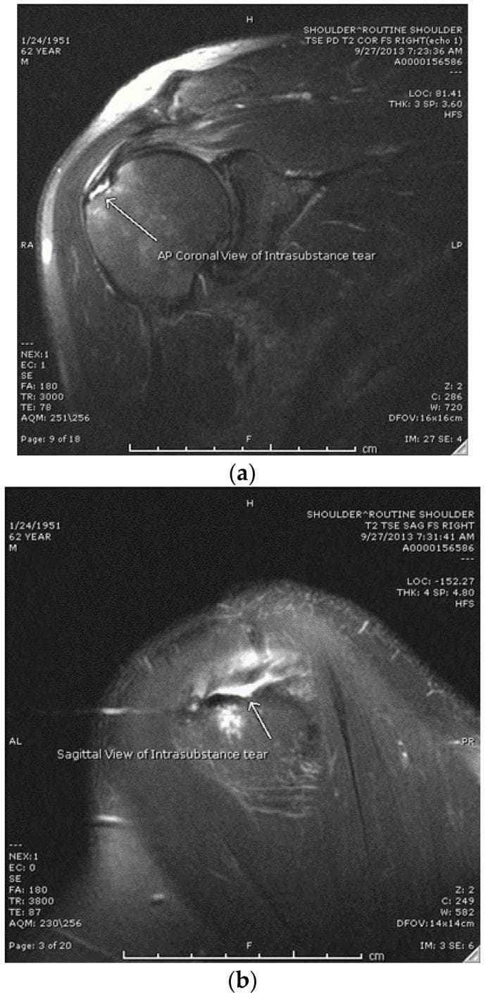 This diagnostic imaging composite displays two T2-weighted magnetic resonance imaging (MRI) views of a right shoulder joint, specifically demonstrating an intrasubstance rotator cuff tear. Figure (a) is a coronal T2 Turbo Spin Echo (TSE) Fat-Saturated (FS) image, showing the glenohumeral joint and the supraspinatus tendon. A white arrow indicates a localized area of high signal intensity within the tendon substance, which does not communicate with the bursal or articular surfaces. Figure (b) is a sagittal T2 TSE FS image of the same shoulder, providing a cross-sectional view of the rotator cuff muscles and tendons. The arrow in this view confirms the high-intensity fluid signal within the tendon mid-substance, characteristic of a high-grade partial-thickness intrasubstance tear. Key anatomical structures visible include the humeral head, glenoid, and the rotator cuff complex. These images are used in orthopedics and radiology to differentiate intrasubstance tears from articular-sided or bursal-sided partial tears, which is critical for determining surgical versus non-operative management strategies like PRP injections.