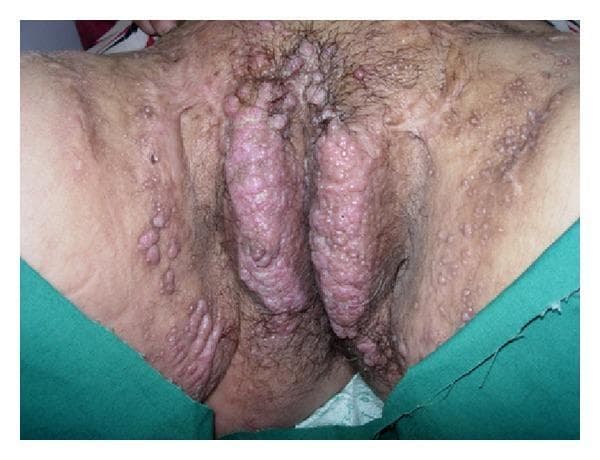 This clinical photograph displays a primary content type of dermatological clinical imaging, specifically focused on the female external genitalia and surrounding inguinal regions. The image demonstrates significant bilateral vulvar lymphedema characterized by marked enlargement and thickening of the labia majora. The affected skin surface is densely covered with multiple, translucent, flesh-colored to erythematous papules and vesicles, ranging in size from a few millimeters to larger confluent clusters. These lesions exhibit a characteristic 'frog-spawn' or 'cobblestone' morphology, typical of lymphangioma circumscriptum. The distribution extends beyond the vulva to involve the mons pubis and the medial inguinal folds. The underlying skin shows signs of inflammation and erythema. This visual evidence illustrates secondary lymphangioma circumscriptum, which often occurs as a late-stage complication of chronic lymphatic obstruction or pelvic surgery, representing the superficial manifestation of deeper lymphatic dilatation.