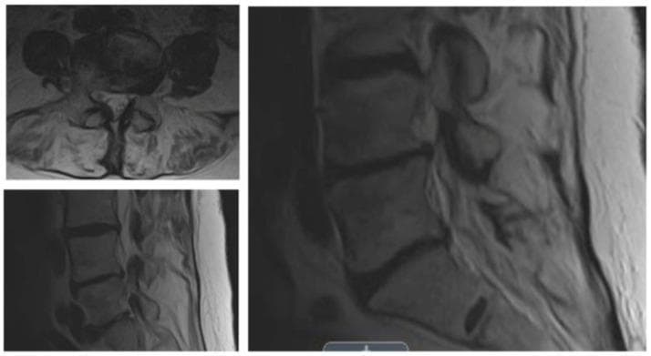 Diagnostic imaging series of the lumbar spine, featuring T1- or T2-weighted MRI scans in both axial (top left) and sagittal (bottom left and right) planes. The sagittal views demonstrate the vertebral bodies, intervertebral discs, and the spinal canal. Notable findings include degenerative changes characterized by reduced disc height and signal intensity variations. There is evidence of moderate-to-severe lateral recess and foraminal stenosis at a single lumbar level, as indicated by the narrowing of the neural exit pathways. The axial view provides a cross-sectional perspective of the vertebral body, facet joints, and the spinal canal, showing narrowing that suggests compression of the neural elements within the lateral recess. These findings are clinically relevant for the diagnosis of neurogenic claudication in patients presenting with progressive leg and back pain. The images serve as an educational example of degenerative spinal pathology and the radiological assessment of foraminal narrowing.