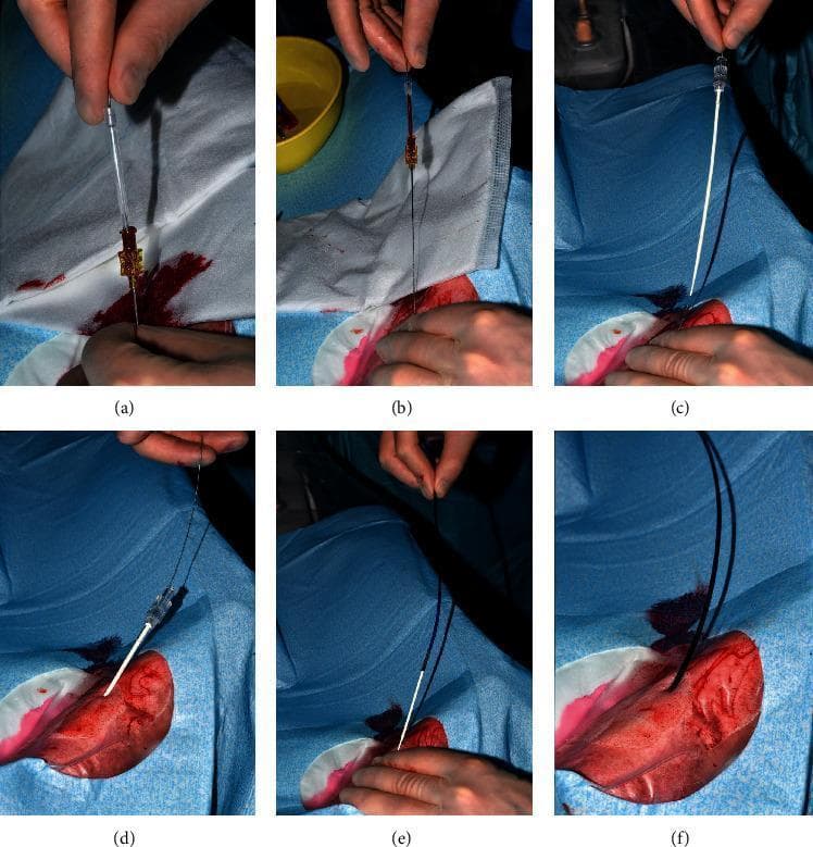 A series of six clinical photographs (a-f) documenting a surgical procedure for direct sheathless guide catheter (SHGC) insertion via the radial artery. The images illustrate a sequential Seldinger-based technique: (a) initial arterial access with a 20G needle followed by the introduction of a 0.025" Silverway guidewire; (b) withdrawal of the needle leaving the guidewire in situ; (c) introduction of a short 15cm dilator over the wire to prepare the tract; (d) the short dilator fully advanced into the radial artery; (e) advancement of the sheathless Hyperion guide catheter, pre-loaded with a long internal dilator, over the guidewire; and (f) the final positioning of the SHGC within the artery. The visual sequence emphasizes the transition from primary access to catheter placement without the use of a traditional introducer sheath, reducing the arterial puncture diameter. The clinical context is interventional cardiology, specifically transradial coronary catheterization, demonstrating the specialized hardware and procedural flow required for sheathless access to minimize vascular complications.