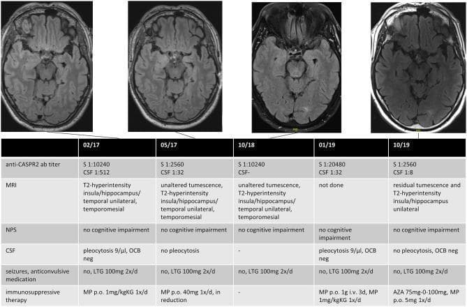 This composite educational resource demonstrates the longitudinal clinical course of a patient with anti-CASPR2 antibody-positive autoimmune encephalitis. The image consists of two primary components: a sequence of four axial brain MRI (FLAIR/T2-weighted) slices and a corresponding data table tracking clinical parameters from February 2017 to October 2019. The MRI scans illustrate the progression of unilateral (right-sided) signal abnormalities, showing initial T2-hyperintensity and tumescence in the insula, hippocampus, and mesial temporal lobe, which transitions to residual tumescence and hyperintensity over the follow-up period. The data table provides a multi-modal timeline correlating these imaging findings with anti-CASPR2 antibody titers in serum and CSF, neuropsychological testing (NPS) results, cerebrospinal fluid (CSF) analysis (pleocytosis and oligoclonal bands), seizure frequency under anticonvulsive medication (Lamotrigin), and immunosuppressive treatment regimens (Methylprednisolon and Azathioprine). This comparison chart is designed to teach the diagnostic and monitoring protocols for autoimmune encephalitis, highlighting the relationship between serological markers, clinical stability, and radiological resolution.