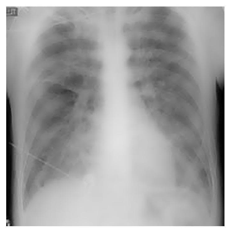 This diagnostic image is a posterior-anterior (PA) or anterior-posterior (AP) chest radiograph. The primary finding is bilateral, diffuse, 'fluffy' opacities throughout both lung fields, consistent with acute pulmonary edema. These opacities are more pronounced in the perihilar regions and mid-to-lower zones, obscuring normal vascular markings and demonstrating a 'bat-wing' or 'angel-wing' distribution pattern. Despite the extensive pulmonary alveolar and interstitial edema, the cardiac silhouette maintains a normal size and shape, without evidence of cardiomegaly or contour abnormalities. This discordance between severe pulmonary edema and a normal cardiac size is often characteristic of non-cardiogenic pulmonary edema or acute cardiogenic failure before ventricular dilation occurs. The mediastinal structures appear central, and the costophrenic angles are partially obscured by the overlying opacities. This image serves as a clinical example of pulmonary congestion and respiratory distress findings in an acute care or emergency medicine context.
