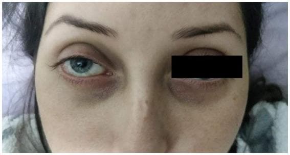 This clinical photograph displays the facial features and periorbital region of a 28-year-old patient. Key diagnostic observations include translucent, fair skin and a narrow nasal bridge. Both eyes exhibit significant infraorbital hyperpigmentation and hollows, often referred to as periorbital dark circles or 'raccoon eyes' appearance, which in this clinical context may relate to underlying vascular pathology or connective tissue disorders like Ehlers-Danlos Syndrome (EDS). The patient's right eye shows mild conjunctival injection at the inner canthus. The patient also demonstrates thin vermilion lips, a characteristic phenotypic feature associated with certain vascular-type connective tissue conditions. This image serves to illustrate the extraocular physical manifestations that can accompany internal vascular emergencies such as carotid-cavernous fistulas or central retinal artery occlusion (CRAO).
