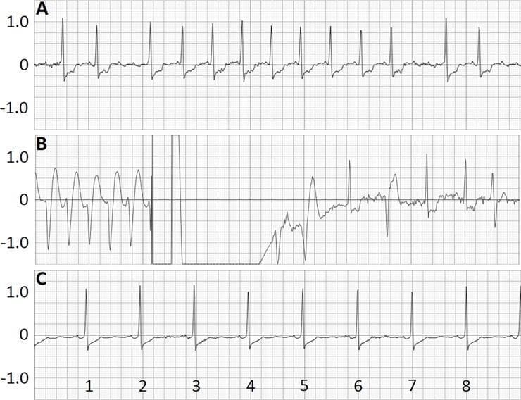 This diagnostic image displays a three-panel electrocardiogram (ECG) recording from a wearable cardioverter-defibrillator (WCD), capturing a critical cardiac event and its resolution. Panel A illustrates atrial fibrillation characterized by an irregularly irregular rhythm, absent P-waves, and significant ST-segment depression recorded four days prior to the event. Panel B shows a sequence of sustained ventricular tachycardia (VT) featuring wide, rapid QRS complexes, followed by a high-amplitude 150J shock artifact. Post-shock, there is a transient period of electrical inactivity (asystole/suppression) leading into the restoration of a more organized rhythm with visible ventricular ectopic beats. Panel C demonstrates the long-term follow-up seven days post-shock, showing a return to a stable sinus rhythm, though persistent ST-segment depression remains visible. The grids are scaled at 25 mm/s (x-axis) and 1 mV/20 mm (y-axis), providing a temporal and voltage-based progression of life-threatening arrhythmia management and successful defibrillation.