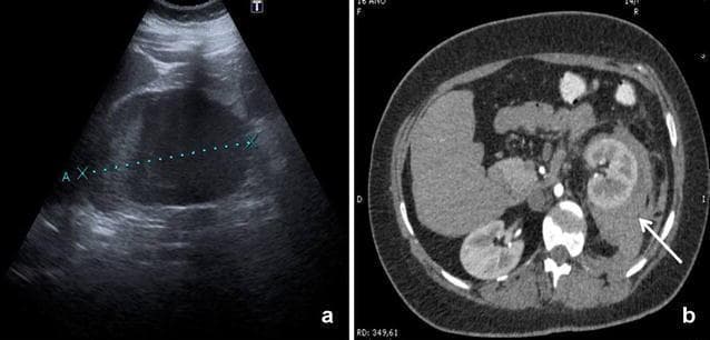 This dual-panel image demonstrates a left-sided retroperitoneal hematoma through different imaging modalities. Image (a) is a retroperitoneal Extended Focused Assessment with Sonography for Trauma (r-EFAST) ultrasound scan. It shows an anechoic to hypoechoic fluid collection in the left perirenal space, with electronic callipers (dotted line marked 'A' and 'X') measuring the 1.5 cm hematoma. Image (b) is an axial contrast-enhanced CT scan of the abdomen. It reveals a hyperdense collection representing a combined perirenal and pararenal hematoma (indicated by a white arrow). The hematoma is situated adjacent to the left kidney, causing anterior displacement of the renal parenchyma. These images illustrate the diagnostic utility of specialized ultrasound protocols (r-EFAST) compared to gold-standard CT imaging for detecting retroperitoneal bleeding following invasive medical procedures. The clinical significance lies in the rapid identification of post-catheterization complications in patients presenting with flank pain and hemodynamic instability.