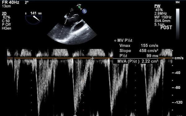 This diagnostic image shows a split-screen echocardiogram used to determine the Mitral Valve Area (MVA) via the pressure half-time (PHT) method. The upper section contains a 2D transesophageal echocardiography (TEE) view in a mid-esophageal aortic valve long-axis orientation, showing the placement of the Doppler sample volume. The lower section displays a Pulsed-Wave (PW) spectral Doppler signal of mitral inflow. The Doppler waveforms appear below the baseline, indicating flow away from the transducer, and exhibit a characteristic E-wave with a measured deceleration slope. Annotations on the right display quantitative hemodynamics: a maximum velocity (Vmax) of 155 cm/s, a deceleration slope of 458 cm/s², and a pressure half-time (P½t) of 99 ms. Based on these values, the calculated Mitral Valve Area (MVA P½t) is 2.22 cm². This imaging is critical for assessing mitral valve function and stenosis severity in a clinical or intra-operative setting.