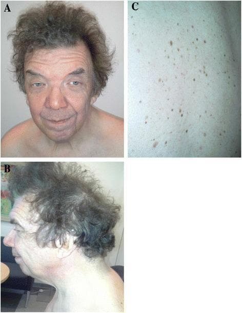 This composite of three clinical photographs displays the phenotypic manifestations of Noonan Syndrome in an adult male. Panel A (frontal view) and Panel B (lateral profile) demonstrate characteristic dysmorphic facial features, including hypertelorism, down-slanting palpebral fissures, and bilateral ptosis (more pronounced on the left). The individual exhibits a broad forehead, a short, widened neck with a low posterior hairline, and distinctively curly, coarse hair. Panel C provides a close-up view of the skin on the back, showing a high density of multiple lentigines. These are small, discrete, pigmented macules ranging in color from light to dark brown, appearing as a scattered distribution of 'freckle-like' lesions. The images collectively illustrate the clinical presentation of a RASopathy, specifically associated with an NRAS mutation, highlighting the multi-systemic involvement of craniofacial morphology and cutaneous pigmentation.