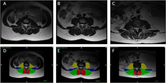 This set of six T2-weighted axial magnetic resonance images (MRI) demonstrates the anatomy of the lumbar spine at the L3/L4 vertebral level. The images compare three female subjects: a healthy control (A, D), an age-matched individual with low back pain (LBP) (B, E), and an older individual with LBP (C, F). Rows A-C show raw radiological data, while rows D-F provide color-coded anatomical segmentations of the paraspinal and core musculature. The segmentations identify the lumbar multifidus (red) adjacent to the spinous process, the erector spinae (green) located postero-laterally, the quadratus lumborum (blue) situated laterally, and the psoas major (yellow) positioned anterior-laterally to the vertebral body. These diagnostic images are designed to illustrate muscular morphology, including variations in muscle cross-sectional area and fatty infiltration associated with aging and chronic pain. High T2 signal intensity (bright areas) within the muscle compartments indicates intramuscular fat or fluid, aiding in the assessment of sarcopenia and tissue quality in clinical and research settings.