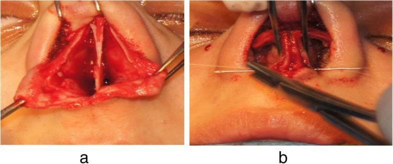 Two-panel clinical photograph illustrating intraoperative steps of a rhinoplasty or septoplasty procedure focusing on the nasal tip and septum. Panel A shows an inferior view of the nasal base with detachment of the membranous septum. This surgical exposure reveals the cartilaginous septum positioned between the medial crura of the lower lateral cartilages. Retractors are used to maintain the surgical field, showing raw, vascularized tissue. Panel B demonstrates the reconstruction phase, where suturing is performed to approximate the medial crura to the caudal septum. A surgical needle holder is visible, placing white suture material to stabilize the nasal tip. The procedure illustrates the anatomical relationship between the septal cartilage and the medial crural footplates, highlighting techniques used to modify nasal tip projection and rotation. This image serves as an educational resource for plastic surgery and otolaryngology residents to understand the 'tongue-in-groove' technique or similar septocolumellar stabilization methods.