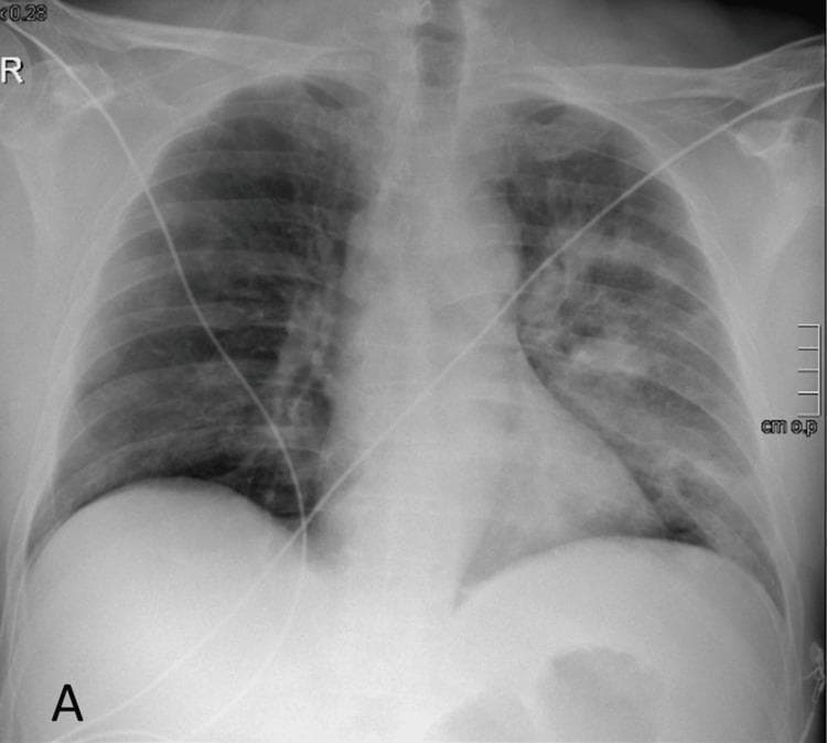 This diagnostic image is an anteroposterior (AP) chest X-ray of an adult male. The primary finding is the presence of patchy, ill-defined alveolar opacities and infiltrates concentrated in the left mid-to-upper lung zones, consistent with lobar or multifocal pneumonia. These infiltrates represent consolidation or inflammatory fluid within the alveolar spaces. The right lung field appears relatively clear, although some mild interstitial markings are visible. The cardiac silhouette and mediastinal contours are within normal limits, with no evidence of cardiomegaly or pleural effusion. External medical equipment is present, including monitoring leads and tubing crossing the thoracic field. The bony structures, including the ribs and clavicles, show no acute fractures or abnormalities. This radiograph demonstrates typical findings of community-acquired pneumonia (CAP) in a clinical setting of septic shock or acute respiratory infection, illustrating the radiographic hallmarks of consolidation and inflammatory lung disease for medical educational indexing.