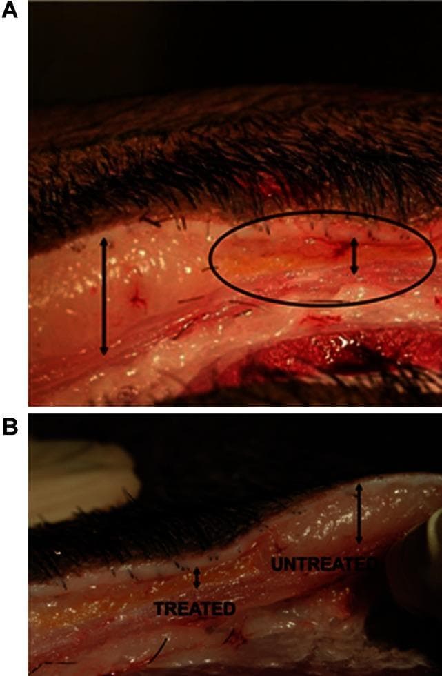 Gross pathologic examination images illustrating the effects of selective thermal or energy-based treatment on adipose tissue. Image A displays a cross-section of skin and subcutaneous tissue. A black circle highlights the treated zone where the yellowish adipose layer appears condensed, discolored, and more heterogeneous compared to the untreated area (indicated by a long vertical arrow). Image B provides a direct side-by-side comparison labeled 'TREATED' and 'UNTREATED'. The treated section shows a marked reduction in the vertical thickness of the subcutaneous fat layer, which appears more compact and atrophic. In contrast, the untreated section demonstrates a preserved, thicker adipose layer with typical lobular morphology. These images demonstrate local fat diminution and adipose tissue destruction, clinically relevant for procedures involving non-invasive body contouring or lipolysis. The visual evidence supports macroscopic findings of tissue alteration and volume loss following therapeutic energy application.