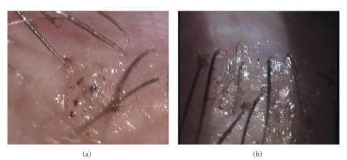 Two high-magnification clinical photographs (a and b) demonstrating Phthiriasis palpebrarum, an infestation of the eyelashes by Phthirus pubis (crab lice). Image (a) depicts a single, translucent, crab-like louse firmly attached to the base of multiple eyelashes and partially embedded within the superficial layers of the eyelid skin. The louse body shows characteristic dark pigmentation and internal spotting, likely representing blood ingestion. Image (b) shows a more extensive involvement of the eyelid margin with multiple lice buried into the lid skin, accompanied by a macerated and edematous skin texture. The visual signs demonstrate the typical presentation of pubic lice in the periorbital region, including the presence of lice (pediculosis) and associated eyelid irritation. This case highlights a common diagnostic pitfall where infestations may mimic blepharitis or eczema. The images are relevant for ophthalmology and dermatology education, illustrating the importance of slit-lamp examination in identifying adult parasites and their nits in patients presenting with eyelid pruritus and hyperpigmentation.