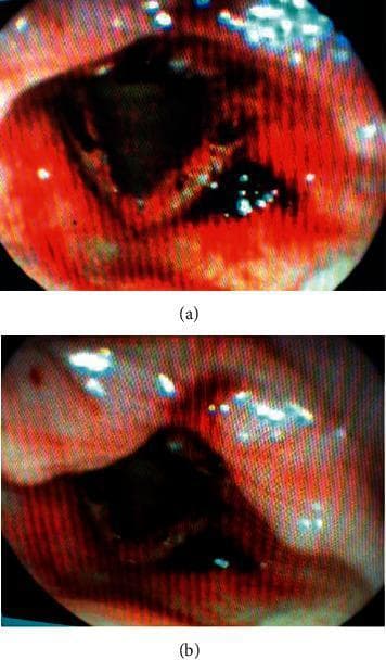 This diagnostic endoscopic image, labeled Figure 2(a) and 2(b), displays the laryngeal anatomy under nasopharyngolaryngoscopy. The visual shows significant pathology of the supraglottis, false vocal folds, and interarytenoid region. There is generalized erythema and intense inflammation across the mucosal surfaces. Key clinical findings include multiple scattered petechiae (small, red hemorrhagic spots) on the supraglottic surface and false vocal folds. Darker, focal areas of scabbing or crusting are prominent, particularly within the interarytenoid region and central glottic area. The glottis appears inflamed with associated mucosal edema. These findings are characteristic of laryngeal mucosal injury or hemorrhage. The images provide a clinical example of upper airway irritation or systemic bleeding manifestations within the larynx, relevant for Otolaryngology (ENT) training and diagnostic classification of vocal fold lesions and laryngeal trauma.