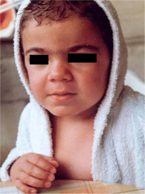 Clinical photograph of a 3-year-old child illustrating the early phenotypic manifestations of Mucopolysaccharidosis type II (MPS II), also known as Hunter syndrome. The image focuses on the patient's head and upper torso, demonstrating mild coarsening of facial features characteristic of lysosomal storage disorders. Key visual findings include a slightly flattened midface with a depressed nasal bridge, full and rounded cheeks, and thickened lips, particularly the upper lip. The hair appears somewhat coarse and dark. The eyes are obscured for patient privacy. This clinical visual serves as an educational tool for medical professionals to recognize subtle facial dysmorphism that precedes the more severe somatic and neurological symptoms of MPS II. The identification of such features at an early age is critical for timely diagnostic intervention and metabolic evaluation in pediatric populations.