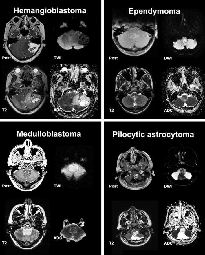 A comparative diagnostic imaging panel displaying four representative posterior cranial fossa tumors—Hemangioblastoma, Ependymoma, Medulloblastoma, and Pilocytic Astrocytoma—across four MRI sequences: post-contrast T1-weighted (Post), T2-weighted (T2), Diffusion-Weighted Imaging (DWI), and Apparent Diffusion Coefficient (ADC) maps. The Hemangioblastoma demonstrates a cystic morphology with a heterogeneously enhancing mural nodule and high ADC signal. The Ependymoma shows homogeneous enhancement and mixed ADC signal. The Medulloblastoma is characterized by significant restricted diffusion, indicated by high signal on DWI and corresponding low signal on ADC, typical of highly cellular tumors. The Pilocytic Astrocytoma exhibits a well-defined cystic component with a solid enhancing portion and high ADC signal. These axial views highlight key neuroradiological features used to differentiate common pediatric and adult intra-axial tumors of the cerebellum and fourth ventricle, emphasizing the clinical significance of ADC values and enhancement patterns in neuro-oncological diagnosis.