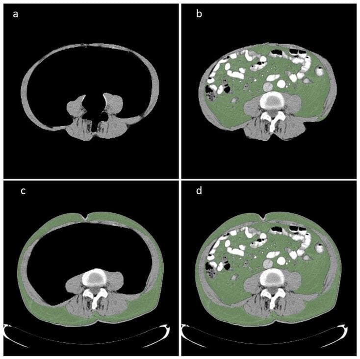 Diagnostic axial CT scans of the abdomen at the level of the umbilicus, demonstrating body composition segmentation for clinical analysis. The four-panel image (a-d) illustrates different adipose and lean tissue compartments highlighted using Hounsfield unit (HU) thresholding. Panel (a) shows the isolated skeletal muscle mass (SMA), including the abdominal wall and paraspinal muscles. Panel (b) highlights the visceral fat area (VFA) in green, located within the abdominal cavity and surrounding the internal organs. Panel (c) highlights the subcutaneous fat area (SFA) in green, representing the adipose tissue layer directly beneath the skin. Panel (d) shows the total fat area (TFA), combining both visceral and subcutaneous compartments. This radiological segmentation is used to calculate indices like the skeletal muscle index (SMI) and to assess for conditions such as sarcopenia, obesity, or sarcopenic obesity, which serve as prognostic markers in surgical and oncological contexts.