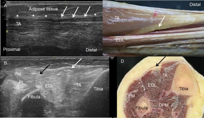 Educational multi-panel figure demonstrating the musculoskeletal anatomy of the anterior and lateral leg compartments through ultrasound and cadaveric correlation. Panel A shows a long-axis ultrasound view of the tibialis anterior (TA) muscle at its origin from the crural fascia (marked by asterisks), highlighting a hypoechogenic area (arrows) corresponding to adipose tissue. Panel B presents a short-axis ultrasound at the middle third of the leg, identifying the tibialis anterior (TA), extensor digitorum longus (EDL), and peroneus longus (PL) muscles, with the tibia and fibula as primary osseous landmarks. A hypoechogenic region (white arrow) separates the TA and EDL, while a septum (black arrow) divides the EDL from the PL. Panels C and D provide gross anatomical correlation, including a longitudinal dissection and a transverse cross-section, respectively. These confirm the presence of adipose tissue (arrows) between the TA and EDL and the fascial septa separating the anterior, lateral (PM), and deep posterior muscle (DPM) compartments.