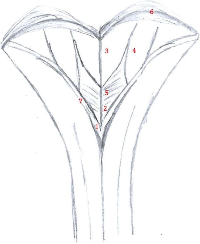 Anatomical diagram depicting the surgical anatomy of the rhomboid fossa, specifically the inferior aspect of the floor of the fourth ventricle. The illustration uses a schematic sketch format to identify key neuroanatomical landmarks. At the most inferior point of the ventricular floor is the obex (1), marking the transition to the central canal. Just superior to the obex lies the area postrema (2). The ventricular floor displays distinct trigones: the trigonum nervi hypoglossi (3) located medially, and the trigonum nervi vagi (5) situated laterally and slightly inferiorly. Further lateral is the area acustica (4). The superior boundary of this region is demarcated by the striae medullares (6), which run transversely across the floor. The lateral borders of the inferior ventricle are formed by the taenia (7). This diagram serves as an educational resource for identifying critical brainstem structures during sub-occipital surgical approaches, emphasizing the spatial relationships within the medulla oblongata's posterior surface.