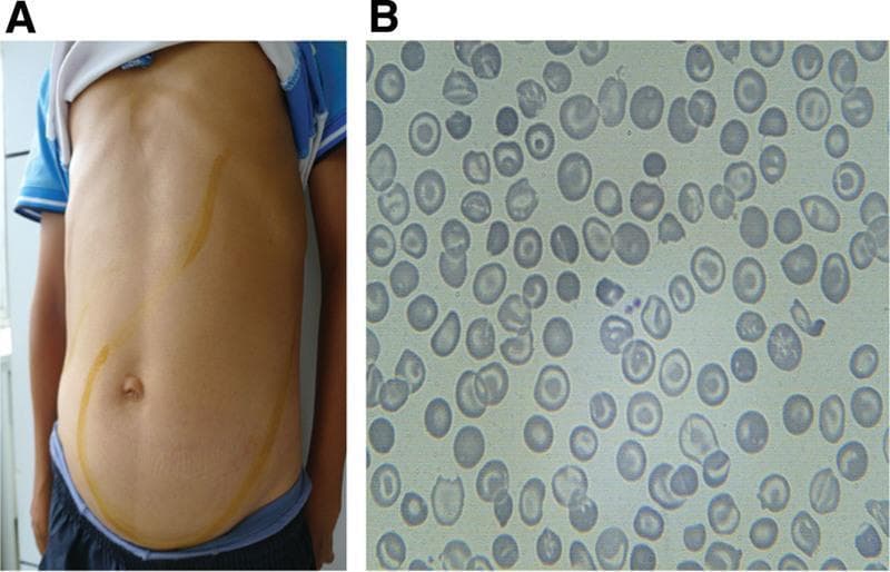 This composite educational image illustrates the clinical signs and laboratory findings of thalassemia intermedia. Panel A is a clinical photograph of a patient's torso showing massive abdominal distention. Yellow skin markings delineate the margins of significant hepatomegaly and massive splenomegaly, with the spleen extending from the left upper quadrant across the midline and deep into the pelvic region, occupying nearly the entire abdominal cavity. Panel B is a peripheral blood smear (light microscopy) demonstrating classic hematological abnormalities associated with thalassemia. The red blood cells exhibit marked microcytosis (small size) and hypochromia (central pallor), along with numerous target cells (codocytes) and irregularly contracted cells (schistocytes). These findings collectively highlight the physical manifestations of extramedullary hematopoiesis and chronic hemolytic anemia characteristic of advanced hemoglobinopathies.
