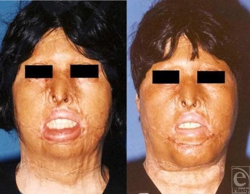 Clinical photograph showing a side-by-side preoperative (left) and postoperative (right) frontal view of a patient with extensive facial scarring and contractures resulting from childhood flame burns. The preoperative image demonstrates significant disfigurement of the mid- and lower face, characterized by lower lip retraction (ectropion), loss of the vermilion border, and obliteration of the natural labiomental and submental folds, leading to a retrusive chin appearance. Severe cicatricial changes affect the skin texture and symmetry of the oral commissures. The postoperative image shows the result of reconstructive plastic surgery involving hinge flaps from subcutaneous fat pads and skin grafting. Key improvements include the restoration of the labiomental crease, increased chin projection (correction of retrogenia), and improved lower lip competence and contour. Although some hypertrophic scarring remains, there is a marked improvement in facial harmony, skin texture, and anatomical landmark definition, specifically regarding the philtrum and chin protrusion.