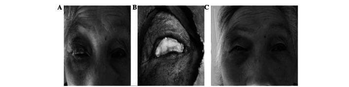 A sequence of clinical photographs documenting the surgical management of an eyelid neoplasm. (A) Preoperative image showing a large neoplasm on the right upper eyelid causing significant distortion of the eyelid margin and obscuring the globe. (B) Intraoperative view following full-thickness excision of the neoplasm, resulting in a large tarsal plate and eyelid margin defect. A transplant involving a trimmed tarsal plate and palpebral conjunctiva is shown being integrated into the surgical defect for reconstruction. (C) Postoperative follow-up at 3 months showing successful healing and functional recovery. The eyelid demonstrates effective closure with no evidence of entropion or ectropion. Notable findings include a minor palpebral fissure height and length discrepancy (greater than 2mm) compared to the contralateral side and mild marginal notching. This sequence serves as an educational tool for eyelid reconstruction techniques using tarsoconjunctival grafts and illustrates outcomes in ocular oncology and oculoplastic surgery.