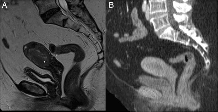 This diagnostic comparison highlights the roles of different imaging modalities in staging endometrial cancer. Image A is a sagittal T2-weighted MRI of the female pelvis showing a 66-year-old patient with grade 3 endometrioid adenocarcinoma. The tumor exhibits intermediate signal intensity and demonstrates deep myometrial invasion (>50% thickness). Key anatomical landmarks include the disruption of the low T2 signal junctional zone (marked by a white asterisk) and the preservation of a thin, low-signal outer myometrial band (indicated by a black arrowhead), consistent with FIGO stage IB. Image B provides a sagittal post-contrast CT scan of the same patient. While CT is utilized for detecting distant metastases, it lacks the soft-tissue contrast resolution seen in MRI, making it difficult to distinguish the specific layers of the uterine wall or the precise depth of myometrial infiltration. This comparison emphasizes MRI's superior sensitivity for local tumor staging and assessing surgical margins in gynecologic oncology.