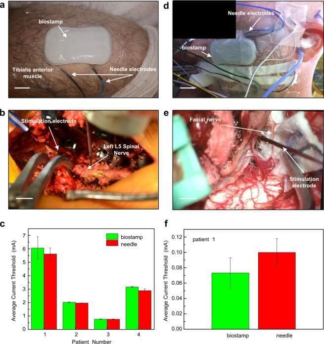 A multi-panel clinical and diagnostic composite demonstrating intraoperative electromyography (EMG) monitoring during spinal and cranial nerve surgeries. (a) Clinical photograph of the lower leg showing the placement of a flexible 'biostamp' sensor on the upper left tibialis anterior muscle and conventional needle electrodes positioned distally. (b) Intraoperative view of a spinal surgical field exposing the left L5 spinal nerve, with a stimulation electrode in direct contact with the neural tissue. (c) Bar graph comparing average current thresholds (mA) between biostamp and needle electrodes for four spinal surgery patients, showing comparable performance. (d) Clinical photograph of the lateral face showing biostamp and needle electrode placement over the facial muscle for cranial nerve monitoring. (e) Intraoperative view of a cranial surgical site showing the exposed facial nerve and an associated stimulation electrode. (f) Bar graph of average current thresholds for a cranial surgery patient, illustrating statistically similar results between the wearable biostamp and traditional needle-based monitoring systems. The composite illustrates the clinical utility of thin, stretchable biosensors in specialized neurosurgical environments.