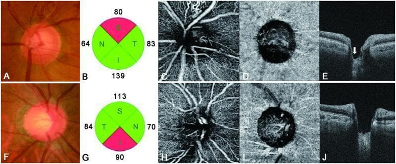 A multi-panel comparison chart using fundus photography, OCT, and OCT angiography (OCTA) to differentiate between Branch Retinal Vein Occlusion (BRVO, top row A-E) and Normal-Tension Glaucoma (NTG, bottom row F-J). Panels A and F show optic disc morphology; BRVO displays focal superior disc notching and retinal nerve fiber layer (RNFL) defects, while NTG shows more generalized and deeper disc cupping. Panels B and G provide circular sector maps of RNFL thickness. Panels C, D, H, and I are en-face OCTA scans of the superficial capillary plexus and choriocapillaris. In BRVO (C), there is a significant focal decrease in peripapillary vessel density in the superotemporal segment corresponding to the site of occlusion. In NTG (H, I), there is a more diffuse reduction in vessel density, particularly in the choriocapillaris layer. Cross-sectional Swept-Source OCT B-scans (E, J) illustrate the lamina cribrosa (LC). The BRVO eye exhibits focal, irregular LC thinning (white arrow), whereas the NTG eye demonstrates deeper, more uniform disc cupping and generalized LC structural changes.