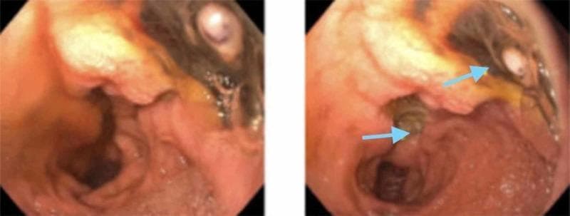 This diagnostic image consists of two endoscopic views of the duodenal bulb, demonstrating a large, cratered duodenal ulcer on the posterior wall. The ulcer measures approximately 35 mm and is characterized by irregular, raised borders and a deep central depression. Within the base of the ulcer, a prominent, non-bleeding visible vessel is identified (indicated by the lower blue arrow in the right panel), which represents a high-risk stigmata of recent hemorrhage (Forrest IIa classification). The surrounding duodenal mucosa appears erythematous, edematous, and friable, consistent with active inflammation. Additional features include yellowish fibrinous exudate and minor areas of dark pigmentation within the ulcer bed. This image serves as a clinical example of severe peptic ulcer disease and the endoscopic identification of vascular structures that necessitate close monitoring or therapeutic intervention for gastrointestinal bleeding.